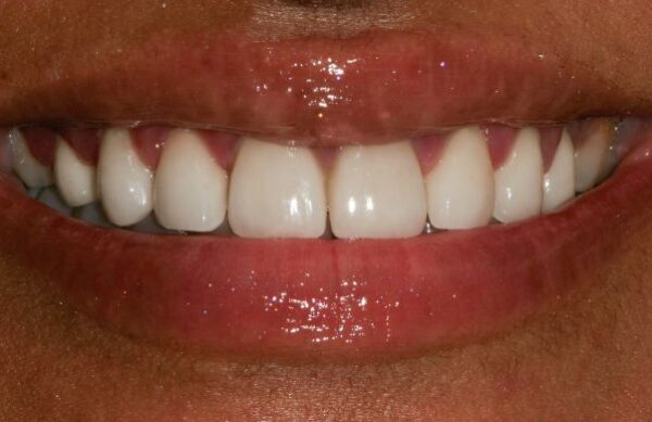 After - Staly Dental