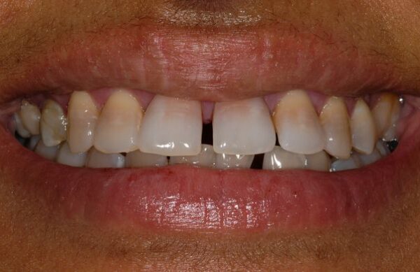 Before - Staly  Dental