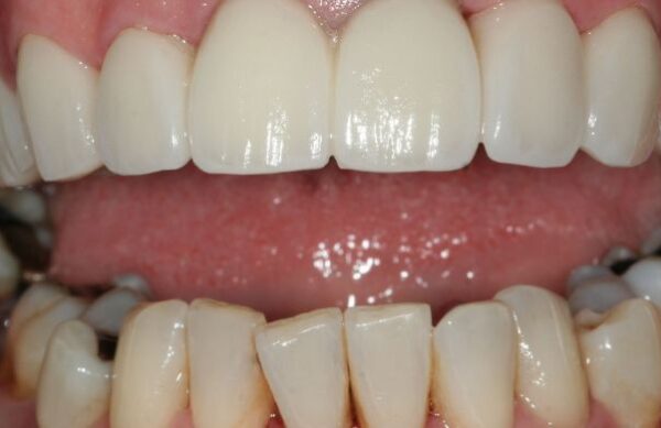 After - Staly Dental