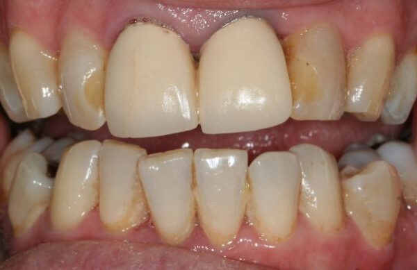 Before - Staly  Dental