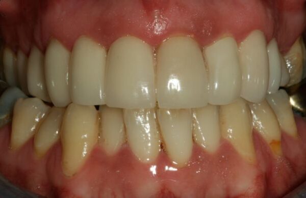 After - Staly Dental