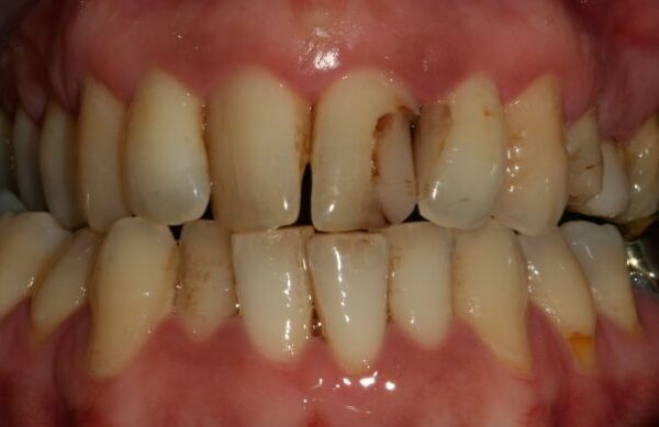 Before - Staly  Dental