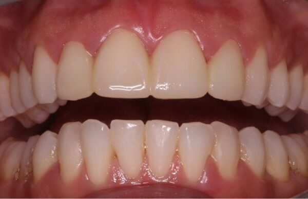 After - Staly Dental