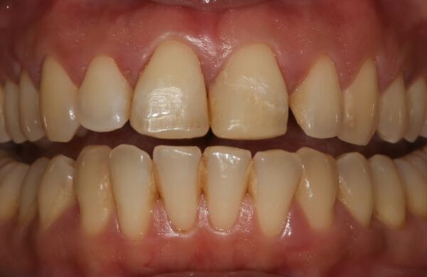 Before - Staly  Dental