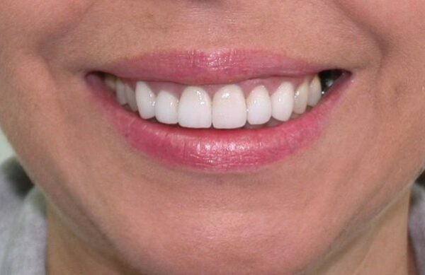 After - Staly Dental