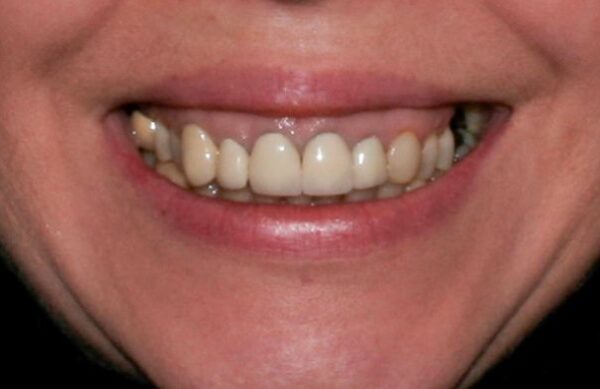 Before - Staly  Dental