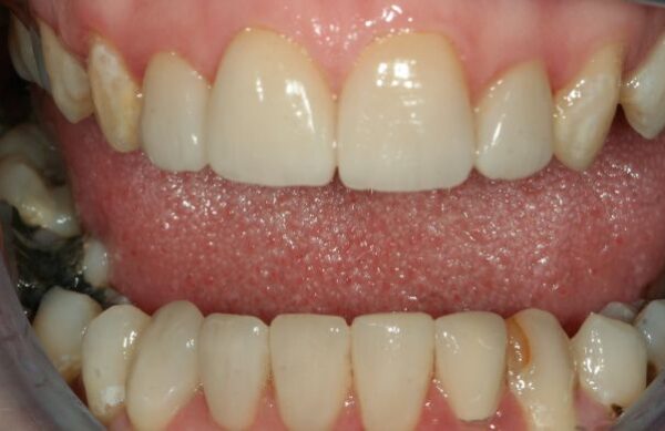 After - Staly Dental