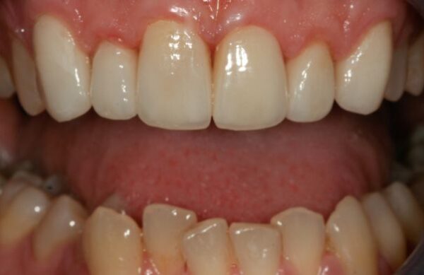 After - Staly Dental