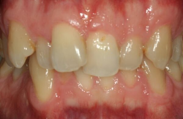 Before - Staly  Dental