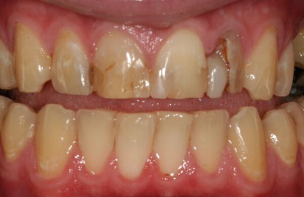 Before - Staly  Dental