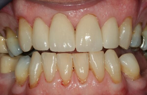After - Staly Dental