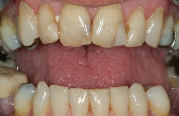 Before - Staly  Dental