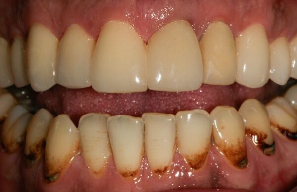After - Staly Dental