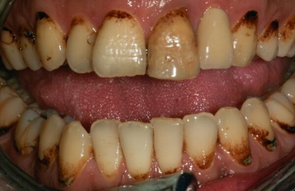Before - Staly  Dental