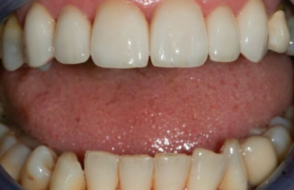 After - Staly Dental