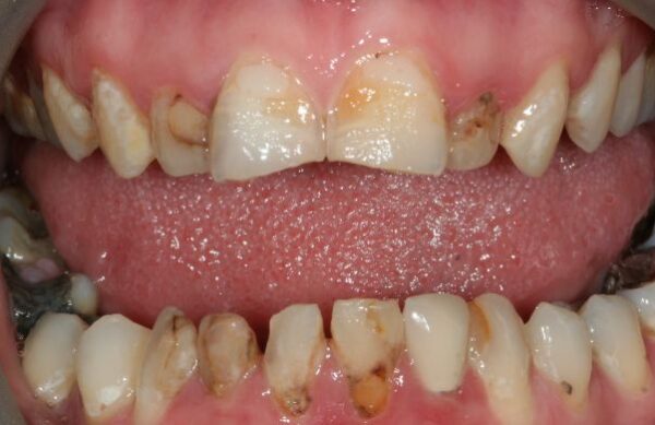 Before - Staly  Dental