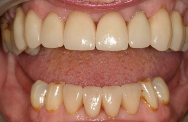 After - Staly Dental