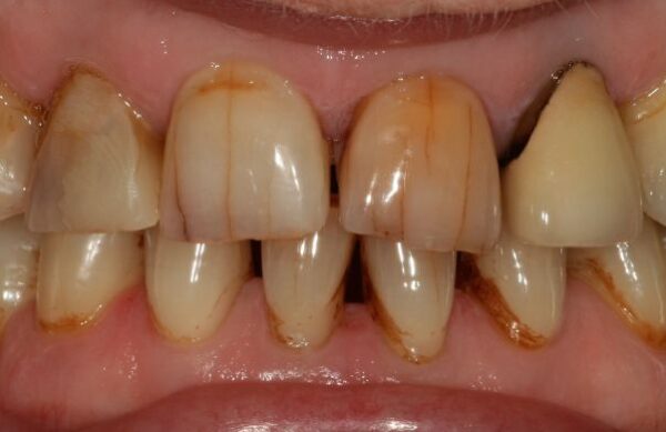 Before - Staly  Dental