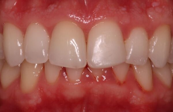 After - Staly Dental
