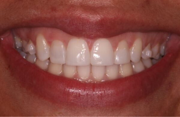 After - Staly Dental