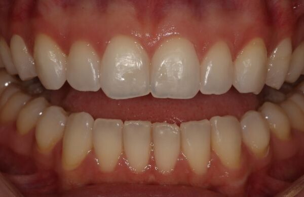 After - Staly Dental