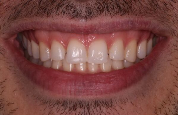 After - Staly Dental