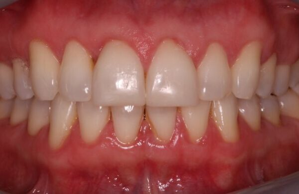After - Staly Dental
