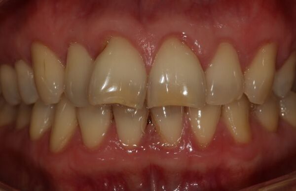 Before - Staly  Dental