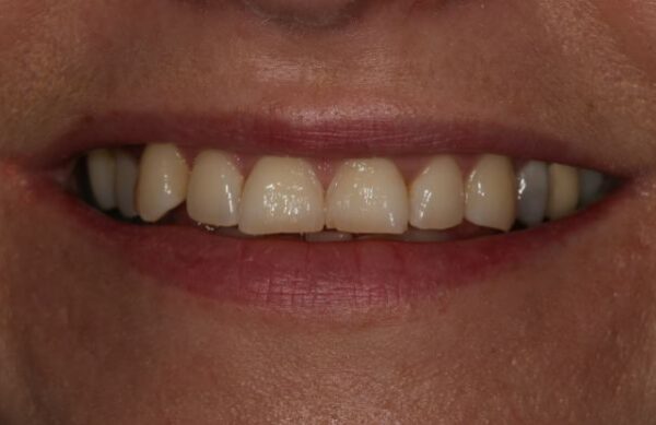 Before - Staly  Dental