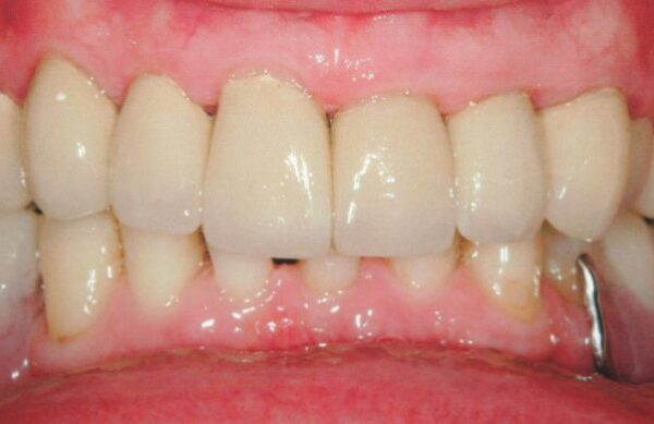 After - Staly Dental