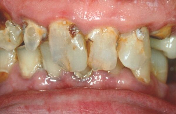 Before - Staly  Dental