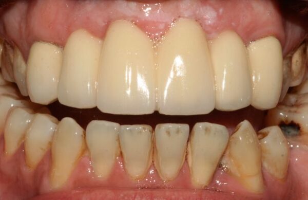 After - Staly Dental