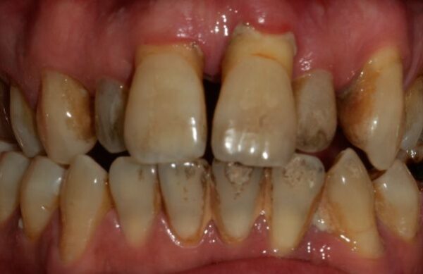 Before - Staly  Dental