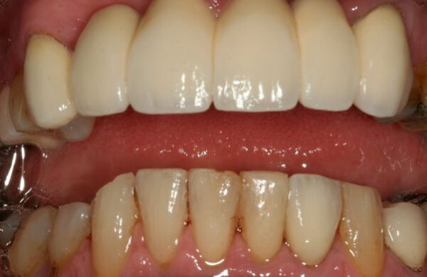 After - Staly Dental
