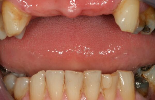 Before - Staly  Dental