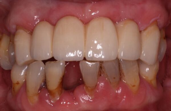 After - Staly Dental
