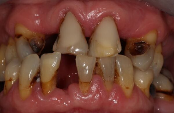 Before - Staly  Dental