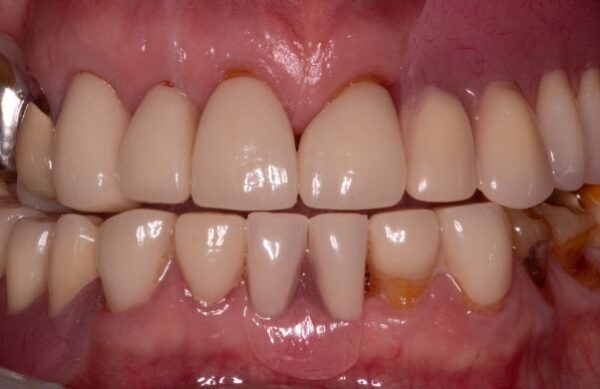 After - Staly Dental