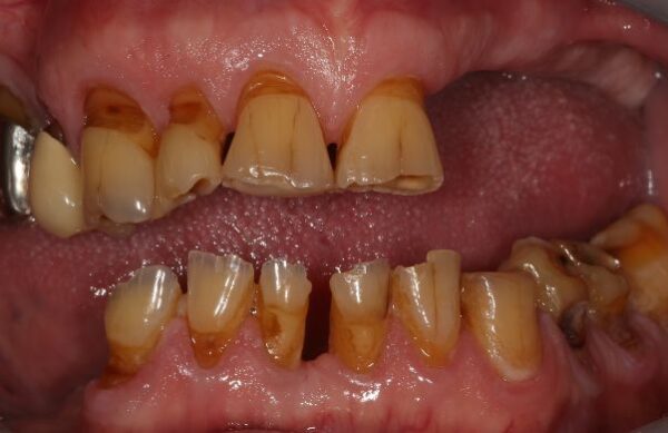 Before - Staly  Dental