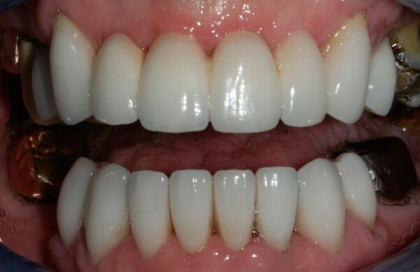 After - Staly Dental