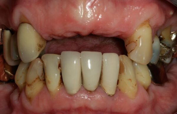 Before - Staly  Dental