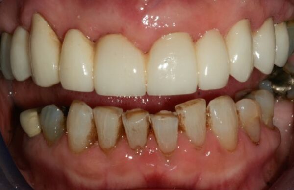 After - Staly Dental