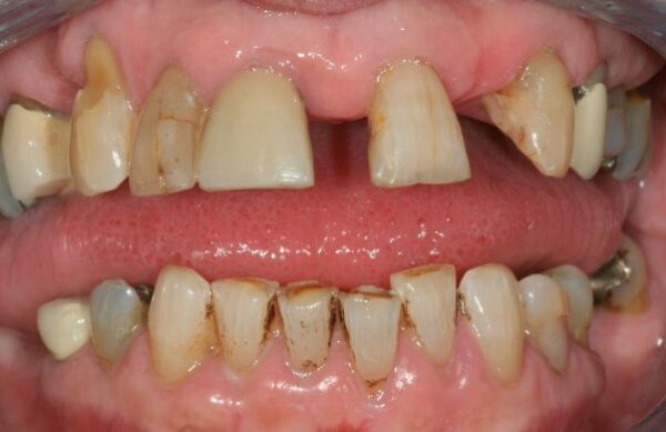 Before - Staly  Dental