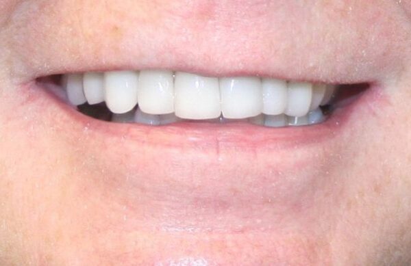 After - Staly Dental
