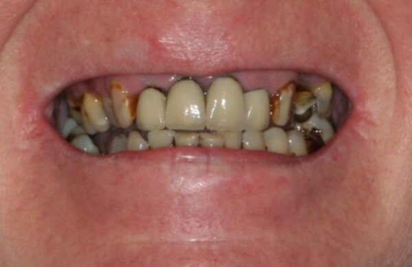 Before - Staly  Dental