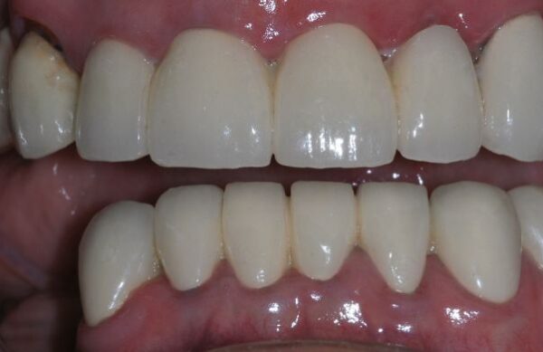 After - Staly Dental