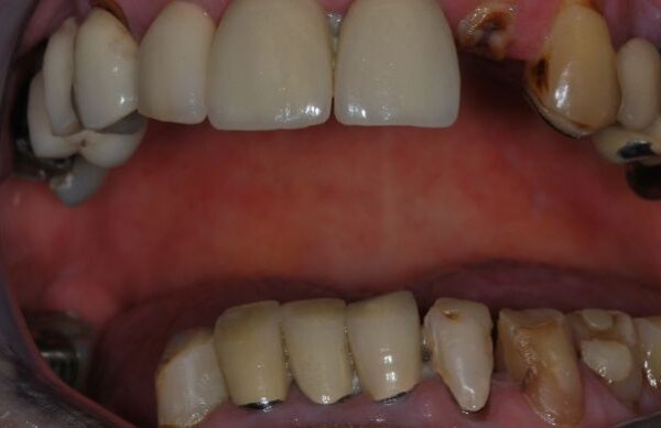 Before - Staly  Dental