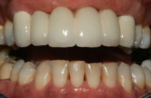 After - Staly Dental