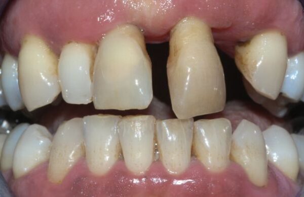 Before - Staly  Dental