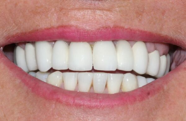 After - Staly Dental